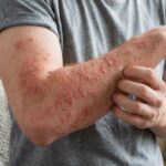 Histamine