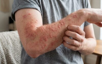 Histamine